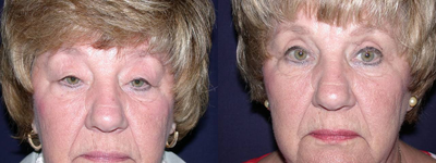Eyelid Surgery before and after photo