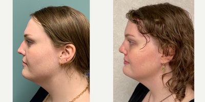 Forehead Reduction before and after photo