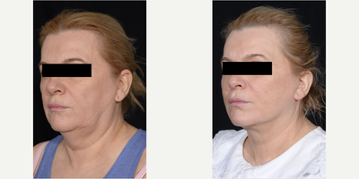 Facelift before and after photo