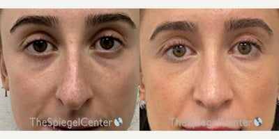Rhinoplasty before and after photo