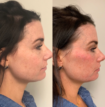 Dermal Fillers before and after photo