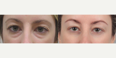 Eyelid Surgery before and after photo