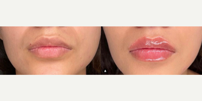 Lip Fillers before and after photo