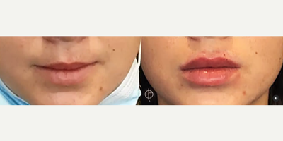 Lip Fillers before and after photo