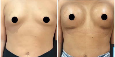 Breast Augmentation before and after photo