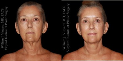 before and after image