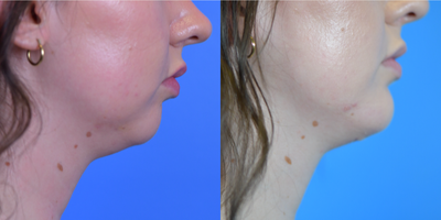 Chin Implant before and after photo