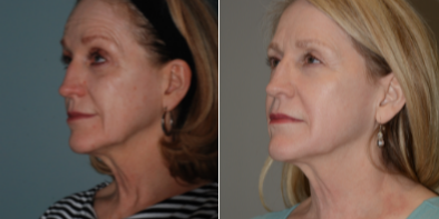 Halo Laser before and after photo
