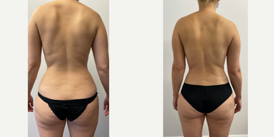 Liposuction before and after photo