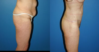 Tummy Tuck before and after photo