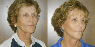Facelift before and after photo