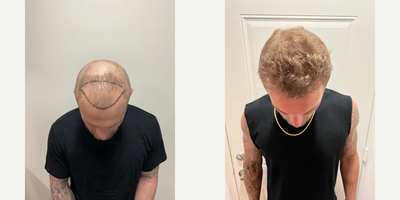 Hair Loss Treatment before and after photo