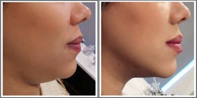 Kybella before and after photo