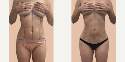 Liposuction before and after photo