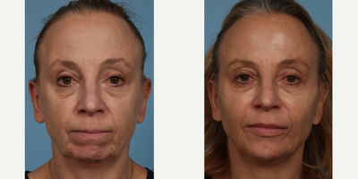 before and after image