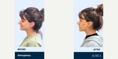 Rhinoplasty before and after photo
