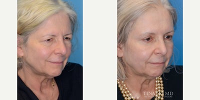 before and after image