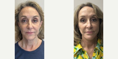 Lip Lift before and after photo