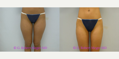 Liposuction before and after photo
