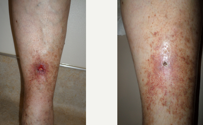 Sclerotherapy before and after photo