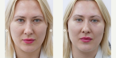 Belotero before and after photo