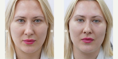 Belotero before and after photo