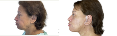 Eyelid Surgery before and after photo