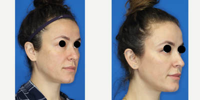 Facial Fat Transfer before and after photo