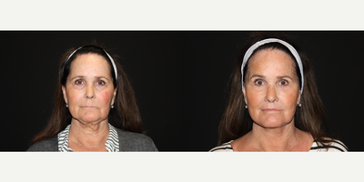 Lip Lift before and after photo