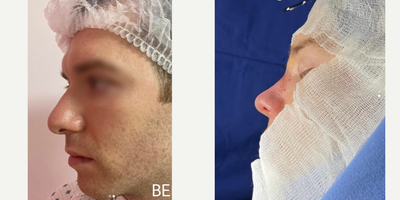 Rhinoplasty before and after photo