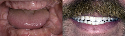 Smile Makeover before and after photo