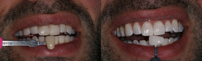Teeth Whitening before and after photo