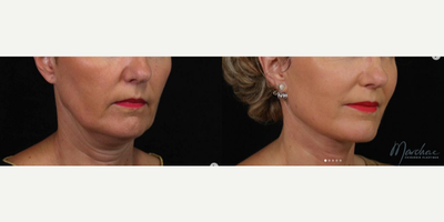 Deep Plane Facelift before and after photo
