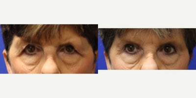 Eyelid Surgery before and after photo