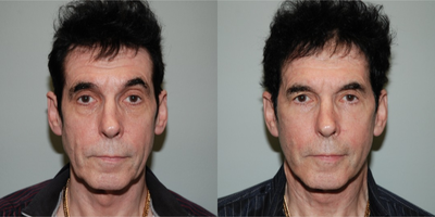 Facelift before and after photo