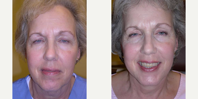 Facelift before and after photo
