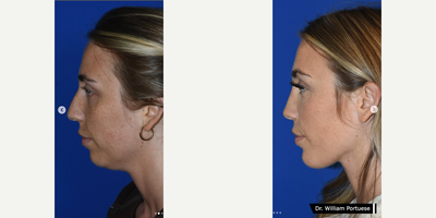 Neck Lift before and after photo