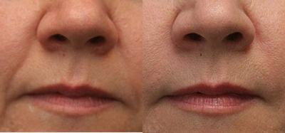 Radiesse before and after photo