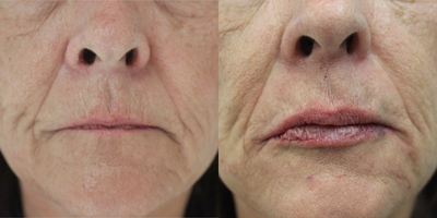 Restylane before and after photo