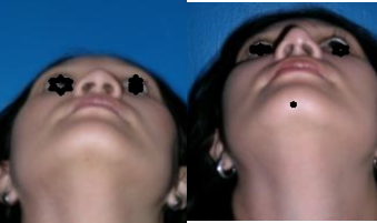 Rhinoplasty before and after photo