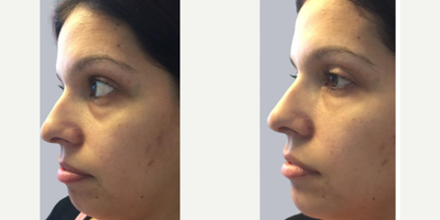 Voluma before and after photo