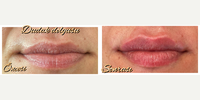 Dermal Fillers before and after photo