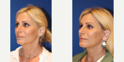 Facelift before and after photo