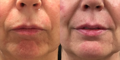 Lip Lift before and after photo
