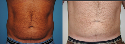 Liposuction before and after photo