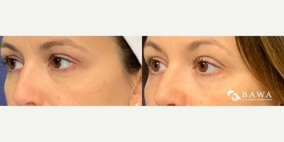 Profound RF before and after photo