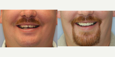 Smile Makeover before and after photo