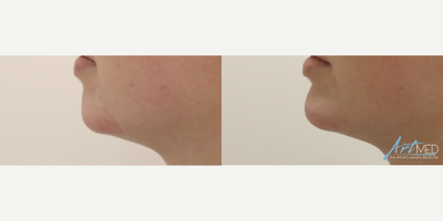 Chin Filler before and after photo
