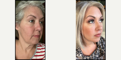 Facelift before and after photo