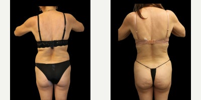 Liposuction before and after photo